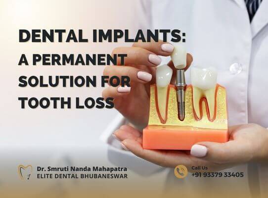 Understanding Dental Implants_ A Permanent Solution for Tooth Loss