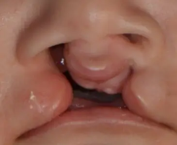 Cleft Lip and Palate Treatment in Bhubaneswar