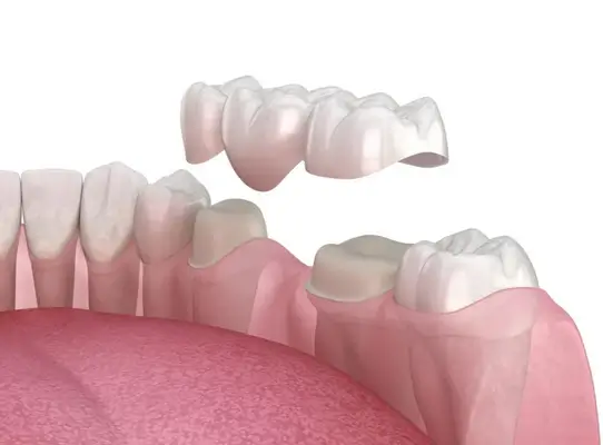 Dental Crowns bbsr