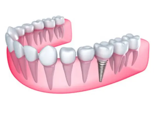 Dental Crowns bhubaneswar