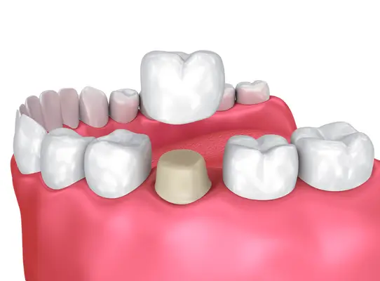 Dental Crowns