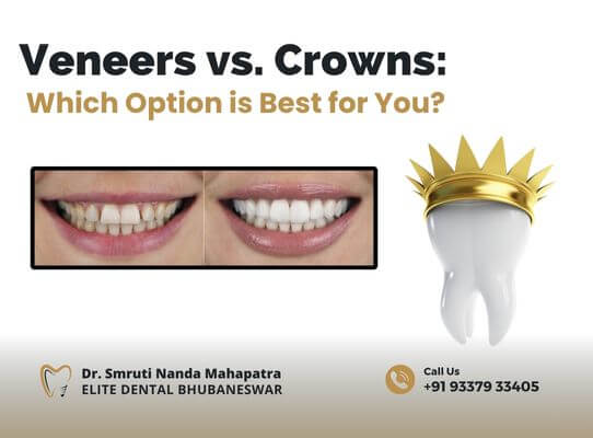 Veneers vs Crowns Treatment in Bhubaneswar