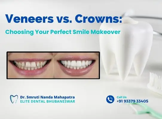 Veneers vs Crowns Treatment in Bhubaneswar