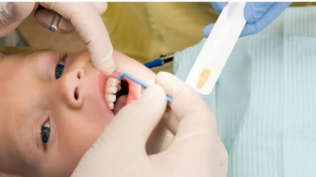 Fluoride Treatments