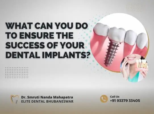 What Can You Do to Ensure the Success of Your Dental Implants