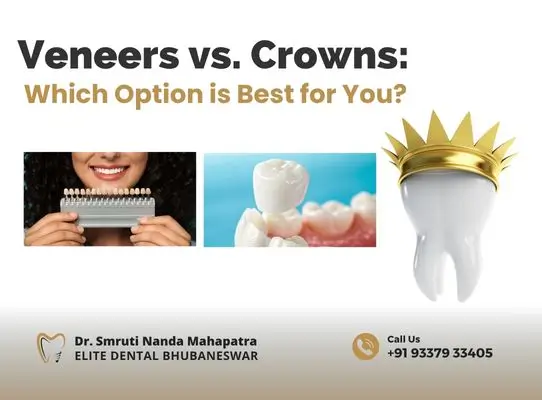 Veneers or Crowns Which Option is Best for You