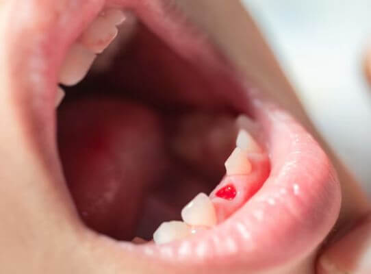 What NOT to Do with a Knocked-Out Tooth
