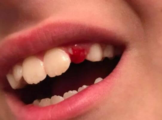 What to Do Immediately After a Tooth is Knocked Out