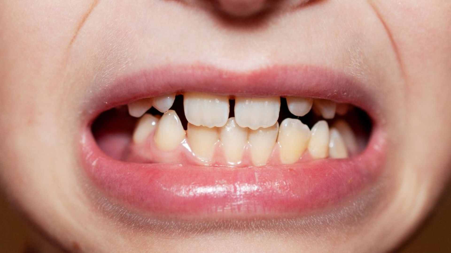 Monitor-Teeth-Development
