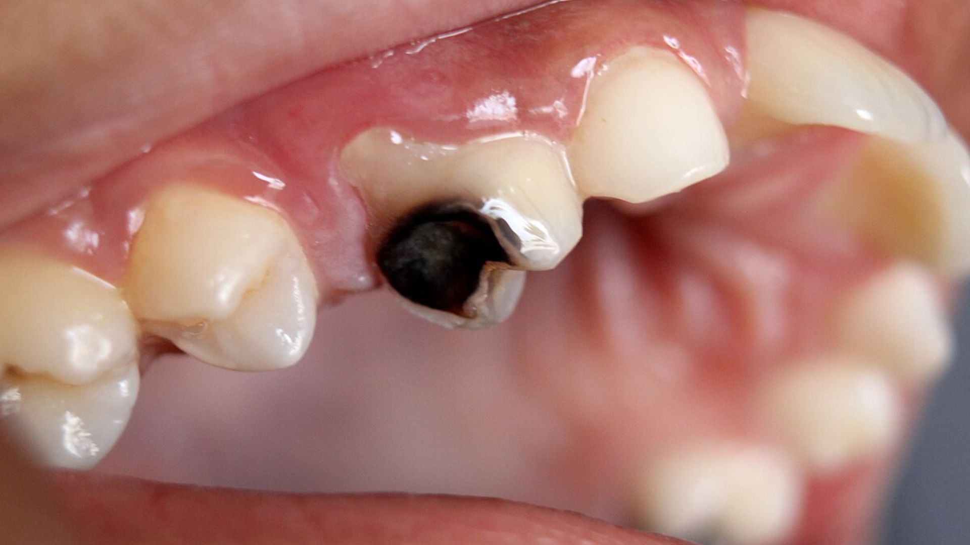 Prevent Tooth Decay Early