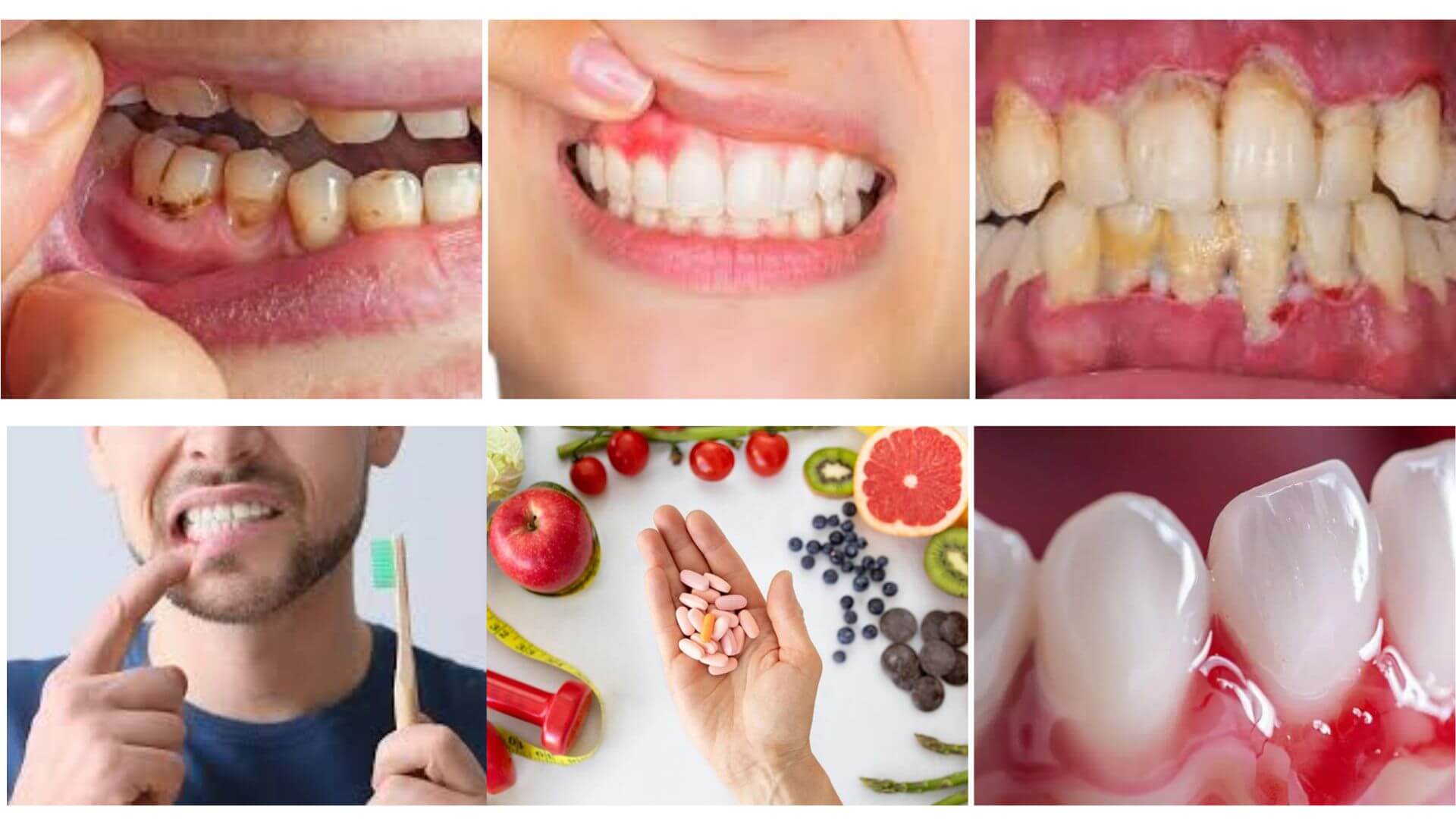 bleeding-gums-warning-sign
