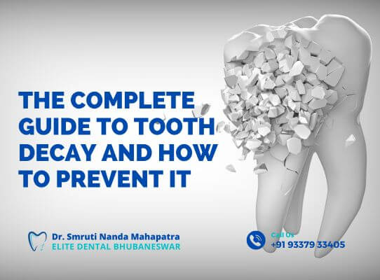 The Complete Guide to Tooth Decay and How to Prevent It