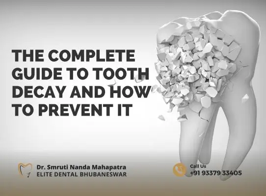 The Complete Guide to Tooth Decay and How to Prevent It