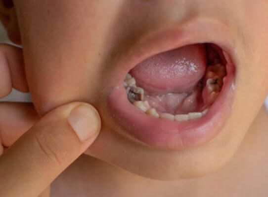tooth-decay-causes-and-prevention