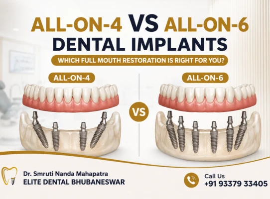 All-on-4 Versus All-on-6 Implant Treatment Guide