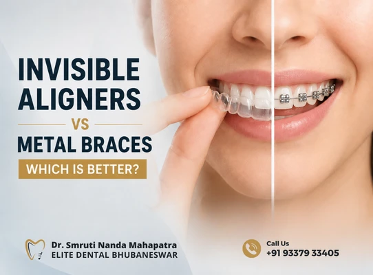 Invisible Aligners vs Metal Braces: Key Differences Compared
