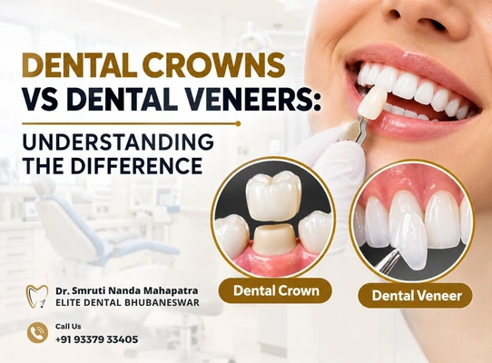 Dental crowns and Dental veneers compared to show differences in tooth coverage and cosmetic restoration.